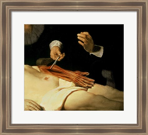 Framed Anatomy Lesson of Dr. Nicolaes Tulp, 1632 (arm detail) Print